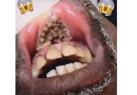 Dad Left Unrecognizable After Losing His Lips And Four Limbs To Flesh Eating Bacteria This Is