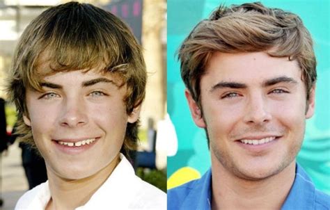 Okay, forget what i said about the beard. Zac Efron before and after plastic surgery (19 ...
