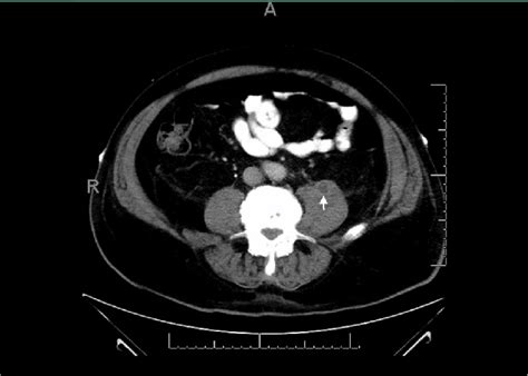 Ct Of The Abdomen Without Iv Contrast With Oral Contrast