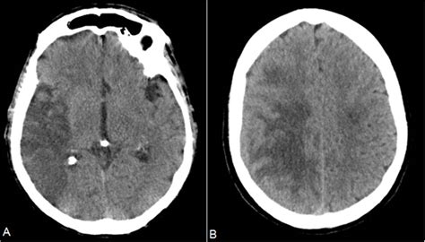 El accidente cerebrovascular isquémico es el resultado de una isquemia cerebral focal asociada a un infarto. El ABC del accidente cerebro vascular en la tomografía ...