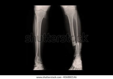 Closed Fracture Left Leg Xray Both Foto Stok 406880146 Shutterstock