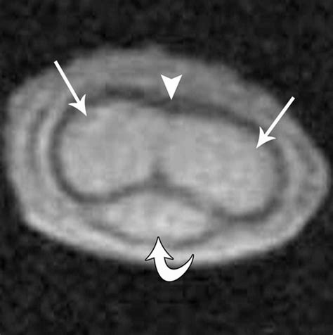 Imaging Of Penile Neoplasms Radiographics