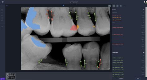 Dental AI Platform For Dental Group Practices Overjet