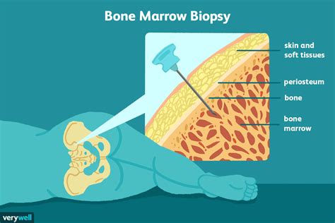 Bone marrow biopsy and bone marrow aspiration are often performed on an outpatient basis in a hospital, clinic or doctor's office. Complete detail about bone marrow biopsy - Sharetok