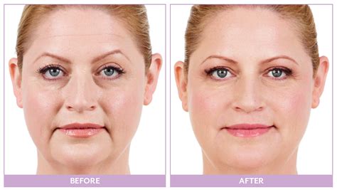 Fillers And Injectables Rejuv Spa And Cosmetic Center