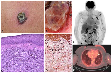 Cutaneous Melanoma Dissemination Is Dependent On The Malignant Cell Properties And Factors Of