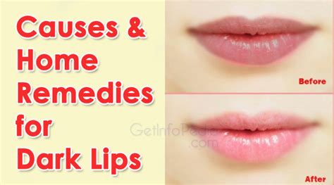 Causes And Home Remedies For Dark Lips