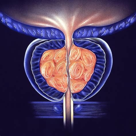 Benign Prostatic Hyperplasia Bph The Urology Group Of Virginia