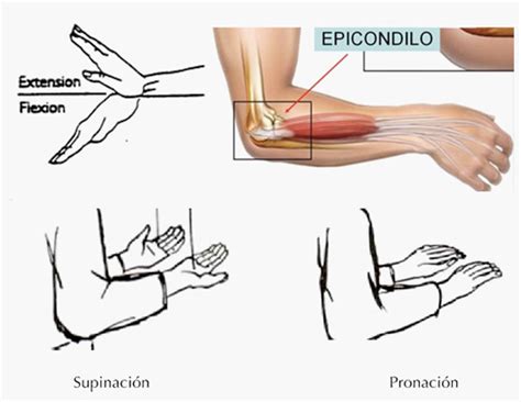 La Epicondilitis Detección Y Tratamiento Traumare