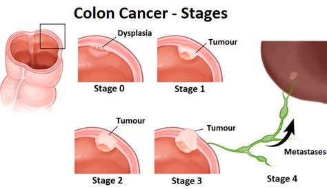 According to the centers for causes. Colon Cancer - Causes, Diagnosis and Treatment
