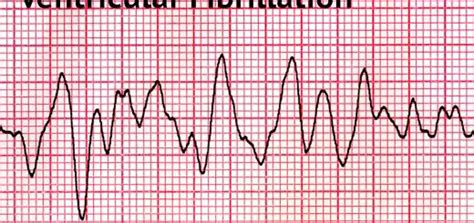 Most Common Heart Rhythm In Pediatric Arrest Best Design Idea