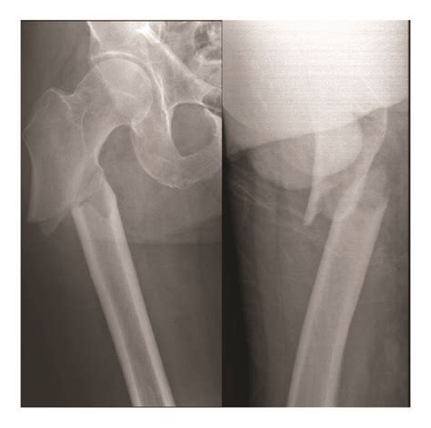 A Atypical Right Subtrochanteric Femur Fracture Created In A