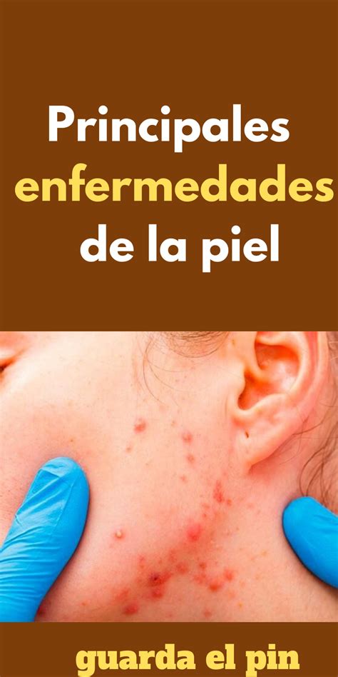 Principales Enfermedades De La Piel Convenience Store Products Pill