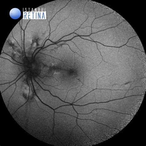 50 Choroidal Neovascularization Associated With Angioid Streaks In