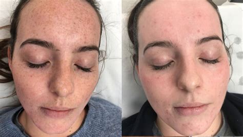 laser freckle removal before and after martyferriola