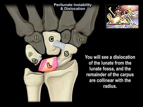 Perilunate Instability Dislocation Everything You Need To Know Dr Nabil Ebraheim Youtube