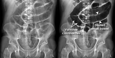 Abdominal X Ray Abnormalities Post Operative Ileus