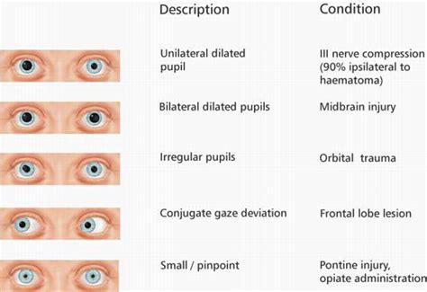 Pupil Size 正常值 瞳孔大小正常值mm Rstlnrok
