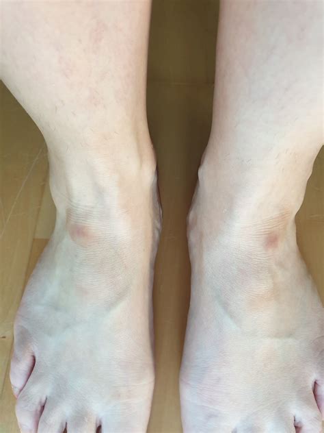 What Are These Bumps On My Feet