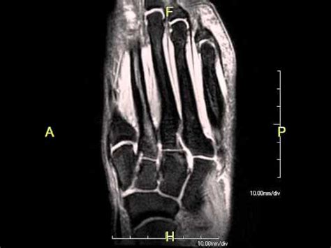 Fore foot MRI - YouTube