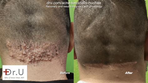 Video Patient Struggling With Razor Bumps Behind Head Find Cure Dru