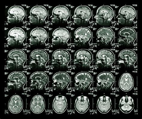 Mri Scans Of A Healthy Human Brain Photograph By Simon Fraser Science
