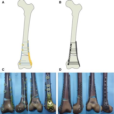 A Model Of AO OTA Classification A Fracture Of Distal Femur Fixed Download Scientific