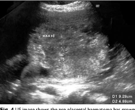 Figure 4 From Massive Pre Placental And Subchorionic Haematoma