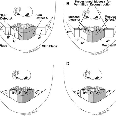 PDF Modified Bilateral Neurovascular Cheek Flap Functional