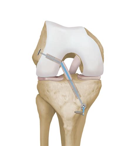 A discretionary access control list (dacl) identifies the trustees that are allowed or denied access to a securable object. Internal Brace in depth - the knee - Mackay Clinic