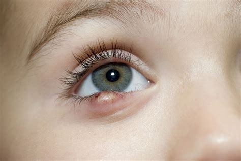 Causes And Treatments Of Styes And Eyelid Bumps