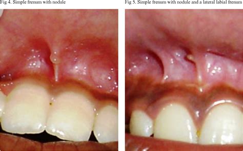 figure 8 from clinical assessment of diverse frenum morphology in permanent dentition