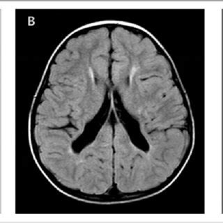 Fri, jul 16, 2021, 4:00pm edt Periventricular leukomalacia (PVL) grades determined on ...