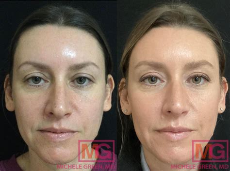 Juvederm Nyc Juvederm Injections For Lines And Wrinkles