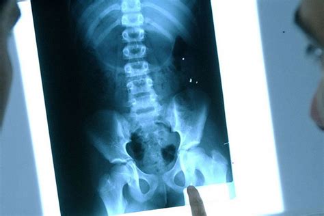 Daughters Secret Body Piercings Revealed To Mom By X Ray Eve Woman