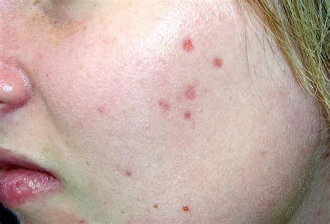 Picture Of Skin Diseases And Problems Erythematous Deep Acne Scars