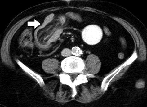 Adult Intestinal Intussusception Ct Appearances And Identification Of