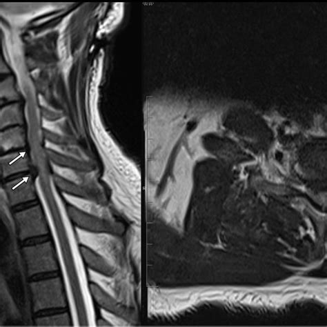 Pre Operative Sagittal A And Axial B T2 Weighted Mri Image Of