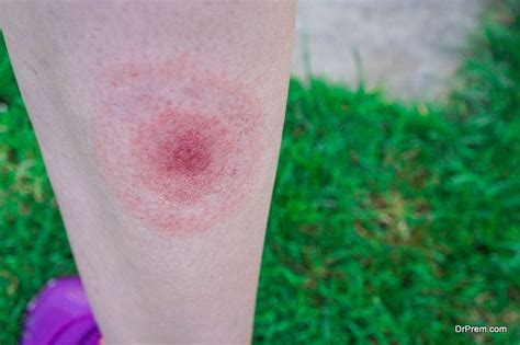 All You Need To Know About Lyme Disease Diy Health Do It Yourself