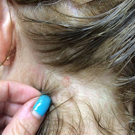 possible scalp ringworm scalp rejuvenation by hairholistic pinterest