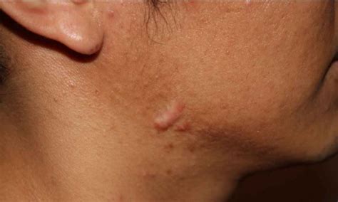 Removal Of Face Acne Scars Raised Pitted Or Darkened Skincarederm