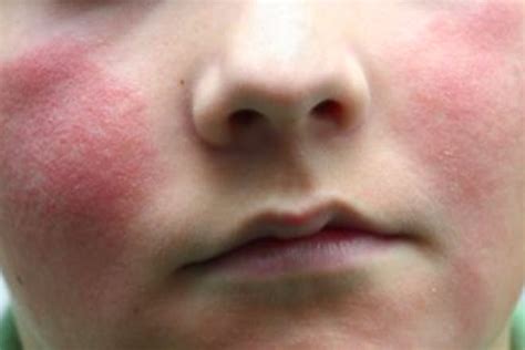 Rashes In Babies And Children Whats My Childs Rash Netmums