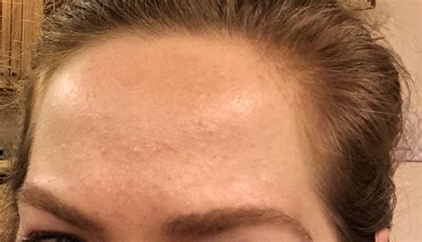 Can Forehead Acne Be Hormonal Health