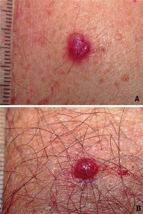 Clinical View Of Two Nodular Pink Lesions Seen As Single Tu