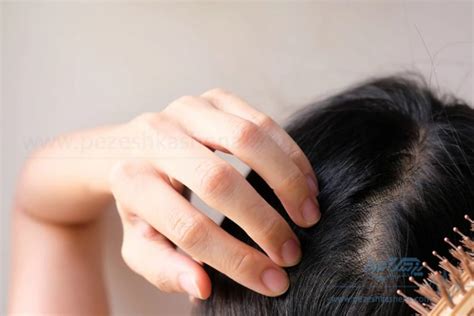اصلی ترین دلیل ریزش مو شدید در زنان به نظر متخصصان پوست