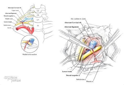 Cervical Rib Removal Illustration By Tziporah Thompson Medical