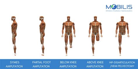 1 Tips You Should Know Before Fitting A Prosthetic Legmobilis