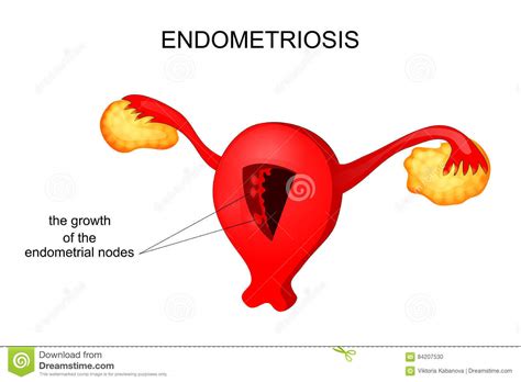 There are 4 stages of endometriosis. The Uterus Affected By Endometriosis Stock Vector ...