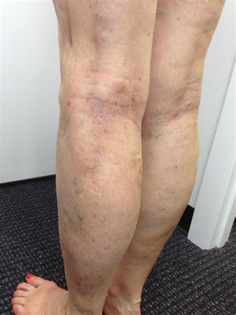 Varicose Vein Results And Post Treatment Photos The Leg Vein Doctor