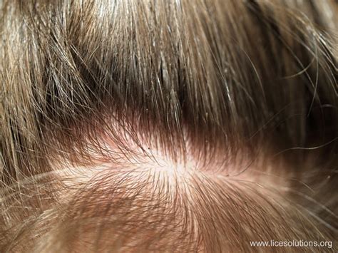 You can try different hair colors in real time thanks to the l'oréal professionel 3d hair makeover app style my hair! Head Lice - Nits on Hair | For more information on ...